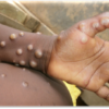 Santé : 2 Cas de la maldie Mpox découverts à Accra