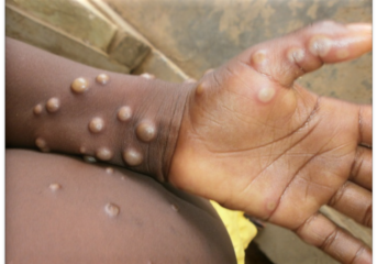Santé : 2 Cas de la maldie Mpox découverts à Accra