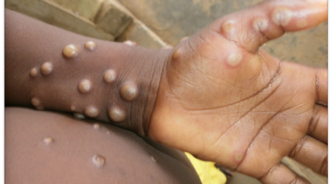 Santé : 2 Cas de la maldie Mpox découverts à Accra