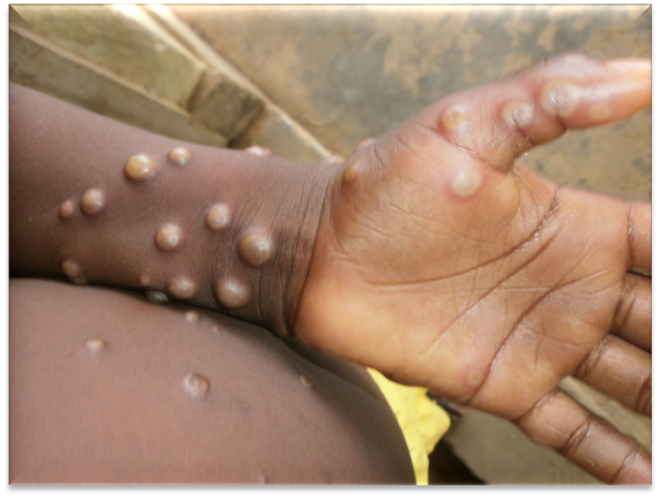 Santé : 2 Cas de la maldie Mpox découverts à Accra