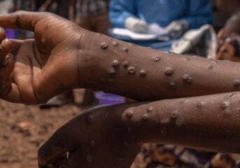 Mpox : Un nouveau cas découvert dans une autre localité du Ghana