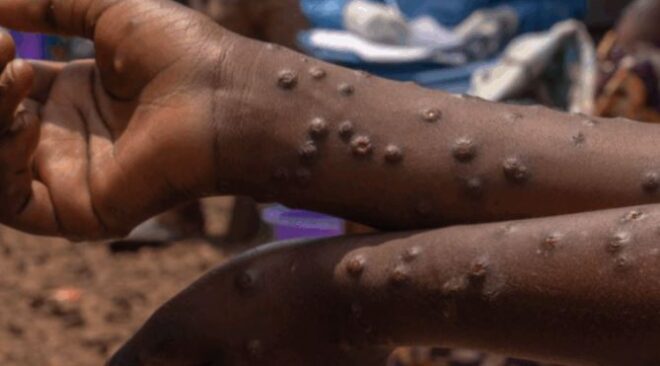 Mpox : Un nouveau cas découvert dans une autre localité du Ghana