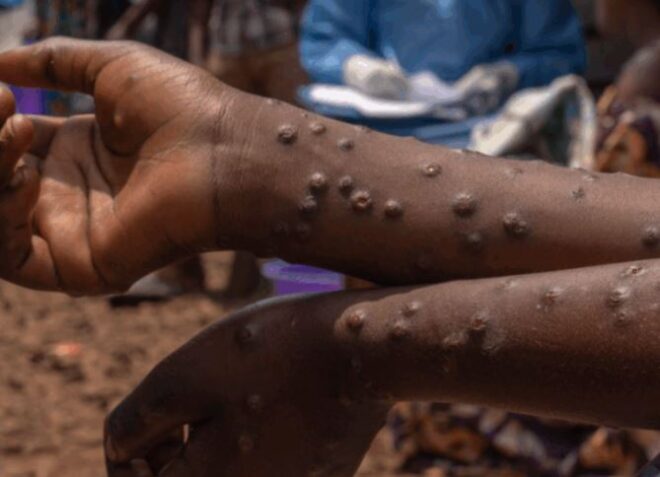Mpox : Un nouveau cas découvert dans une autre localité du Ghana